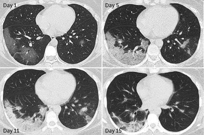 CT snímky 35leté ženy, jež přežila covidový zápal plic. Část poškození přetrvala i po zhruba dvoutýdenní hospitalizaci. Foto Y. Wang a kol., Radiology